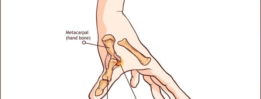 Ulnar Collateral Ligament Injuries of the Thumb