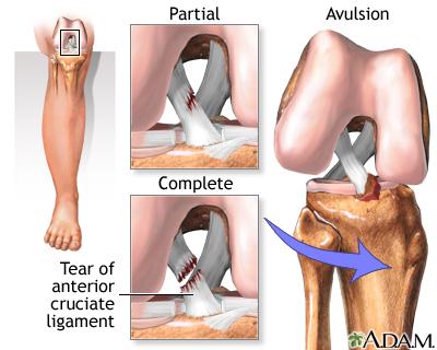 Anterior Cruciate Ligament Injuries