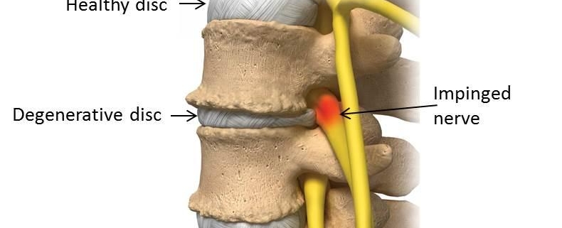 Lumbar Degenerative Disc Disease