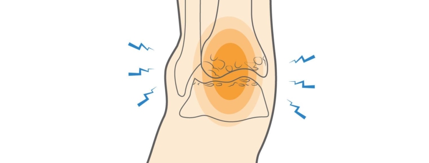 Ankle Arthritis