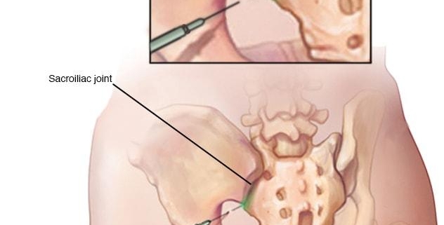 Sacroiliac Joint Injections