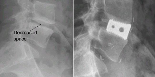 Anterior Lumbar Fusion with Cages