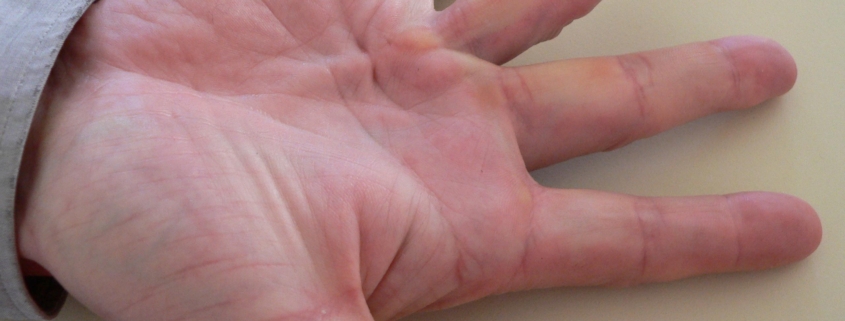 Dupuytren’s Contracture Surgery