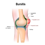 7 Essential Tips for Treating and Preventing Bursitis