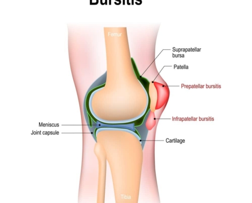 7 Essential Tips for Treating and Preventing Bursitis