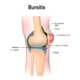 7 Essential Tips for Treating and Preventing Bursitis