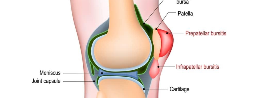 7 Essential Tips for Treating and Preventing Bursitis