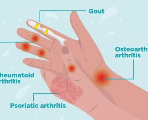 7 Early Signs of Arthritis You Shouldn’t Overlook