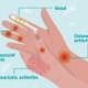 7 Early Signs of Arthritis You Shouldn’t Overlook