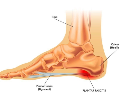 7 Essential Steps to Find Relief from Plantar Fasciitis