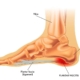 7 Essential Steps to Find Relief from Plantar Fasciitis