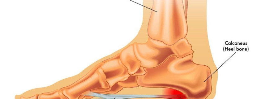 7 Essential Steps to Find Relief from Plantar Fasciitis