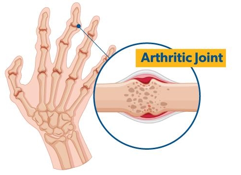 5 Early Signs of Arthritis You Should Never Overlook