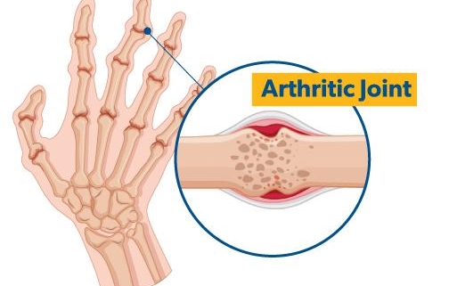 5 Early Signs of Arthritis You Should Never Overlook