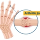 5 Early Signs of Arthritis You Should Never Overlook