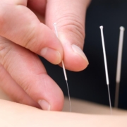 5 Insights on Acupuncture for MSK Pain: Does It Really Help?