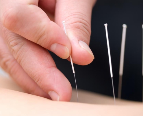 5 Insights on Acupuncture for MSK Pain: Does It Really Help?