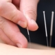 5 Insights on Acupuncture for MSK Pain: Does It Really Help?