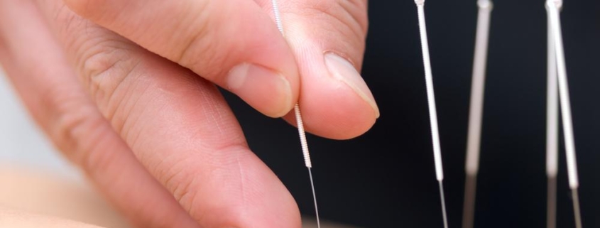 5 Insights on Acupuncture for MSK Pain: Does It Really Help?