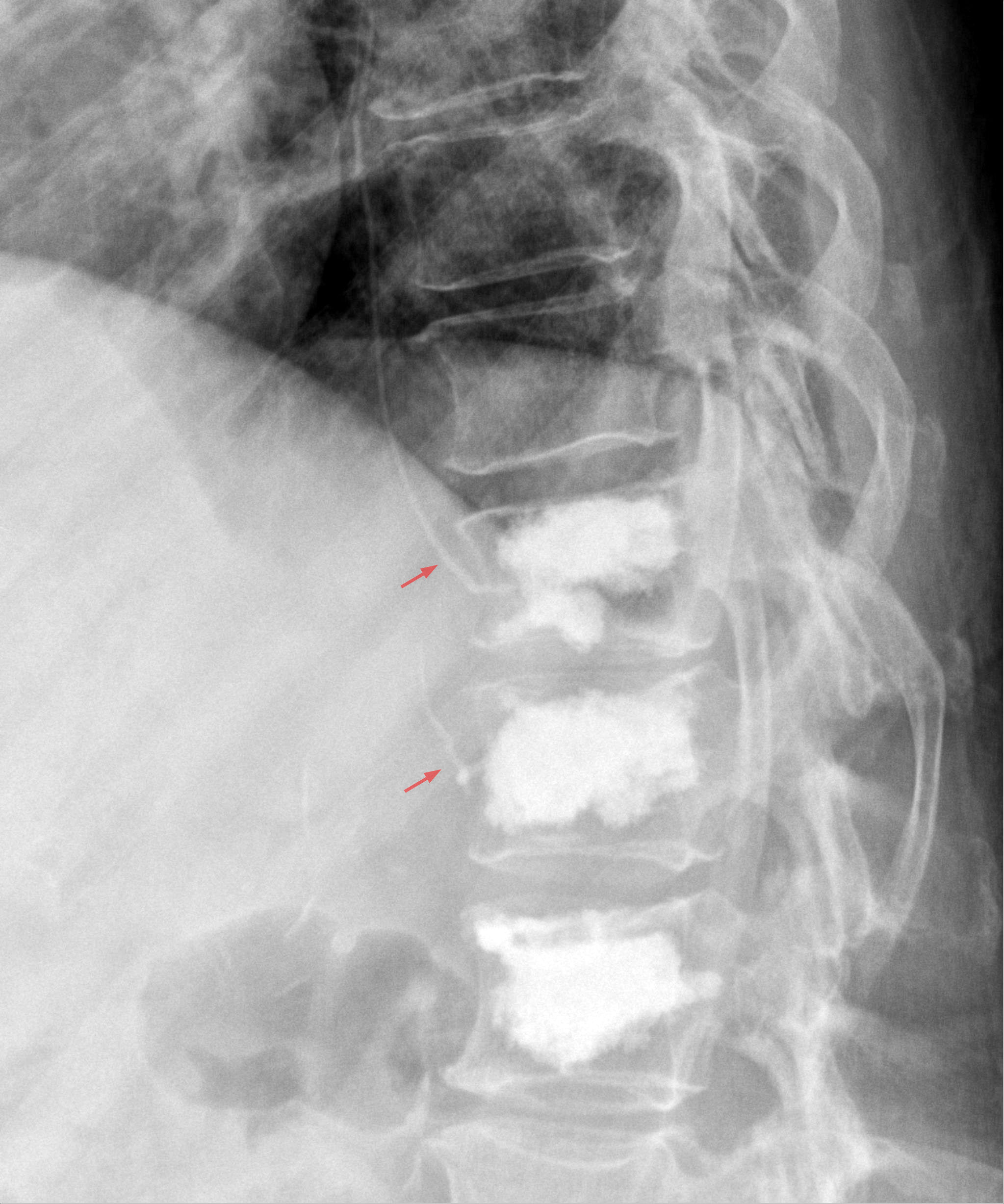 Kyphoplasty - ArthurCare