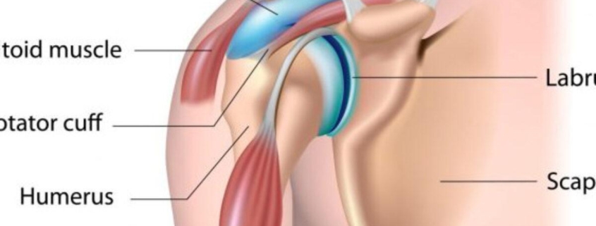 Bursitis: Understanding and Managing Inflamed Bursae