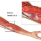 Tendinitis: Understanding and Treating Inflamed Tendons