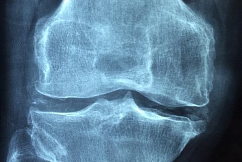 Osteoarthritis: Managing the Wear and Tear on Your Joints