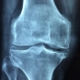 Osteoarthritis: Managing the Wear and Tear on Your Joints