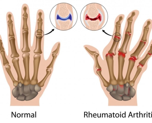 5 Empowering Ways to Thrive with Rheumatoid Arthritis