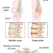 5 Essential Tips for Managing Ankylosing Spondylitis Effectively