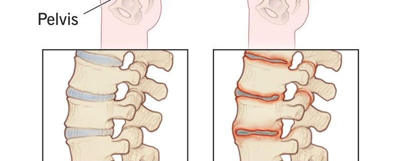 5 Essential Tips for Managing Ankylosing Spondylitis Effectively