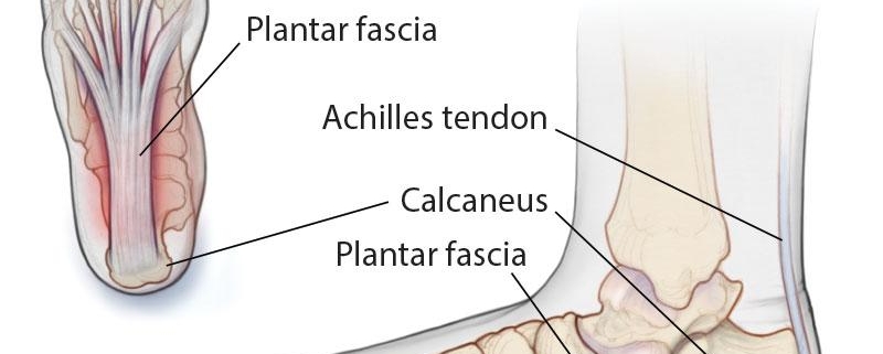 Plantar Fasciitis: Solutions for Heel Pain