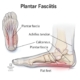 Plantar Fasciitis: Solutions for Heel Pain