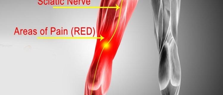 5 Effective Tips to Ease Your Sciatica Pain Naturally