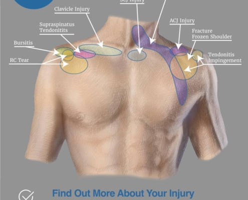 5 Unexpected Triggers of Shoulder Pain and Their Solutions