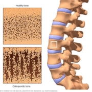 5 Warning Signs of Osteoporosis You Can’t Afford to Overlook