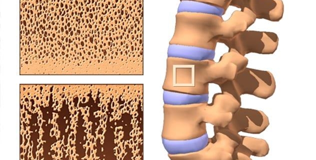 5 Warning Signs of Osteoporosis You Can’t Afford to Overlook